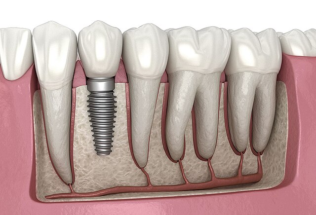 Unveiling the Myths and Facts About Dental Implants